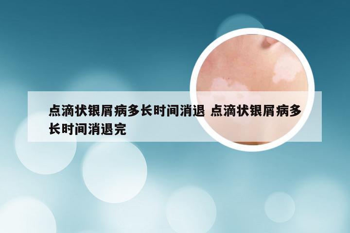 点滴状银屑病多长时间消退 点滴状银屑病多长时间消退完