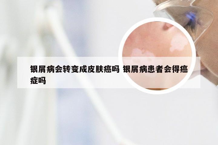 银屑病会转变成皮肤癌吗 银屑病患者会得癌症吗