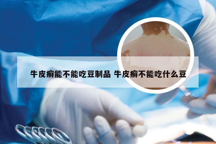 牛皮癣能不能吃豆制品 牛皮癣不能吃什么豆