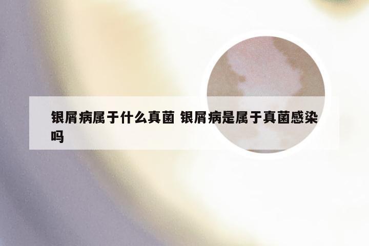 银屑病属于什么真菌 银屑病是属于真菌感染吗