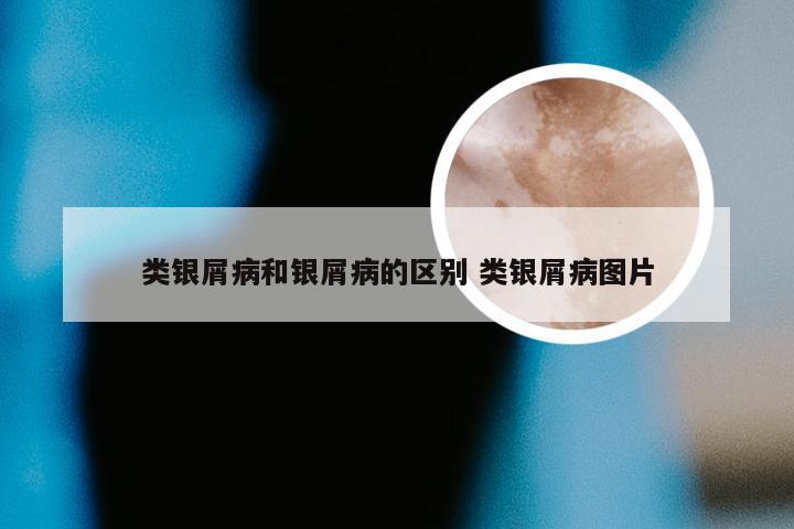 类银屑病和银屑病的区别 类银屑病图片