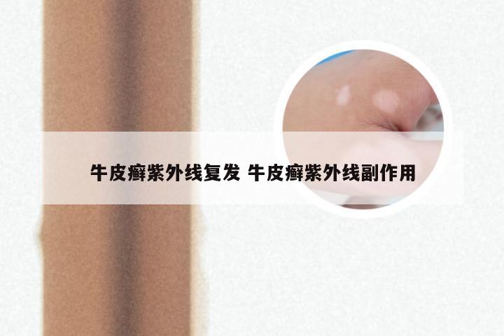 牛皮癣紫外线复发 牛皮癣紫外线副作用