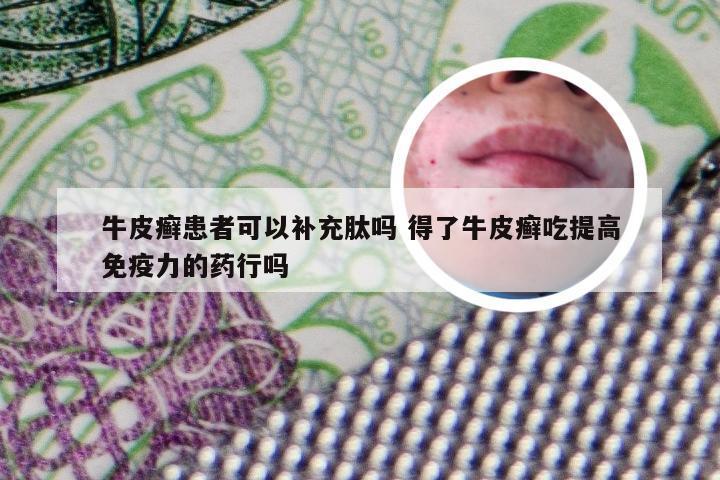牛皮癣患者可以补充肽吗 得了牛皮癣吃提高免疫力的药行吗
