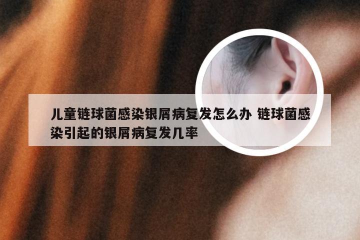 儿童链球菌感染银屑病复发怎么办 链球菌感染引起的银屑病复发几率