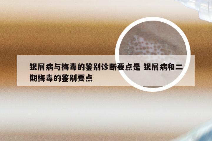 银屑病与梅毒的鉴别诊断要点是 银屑病和二期梅毒的鉴别要点