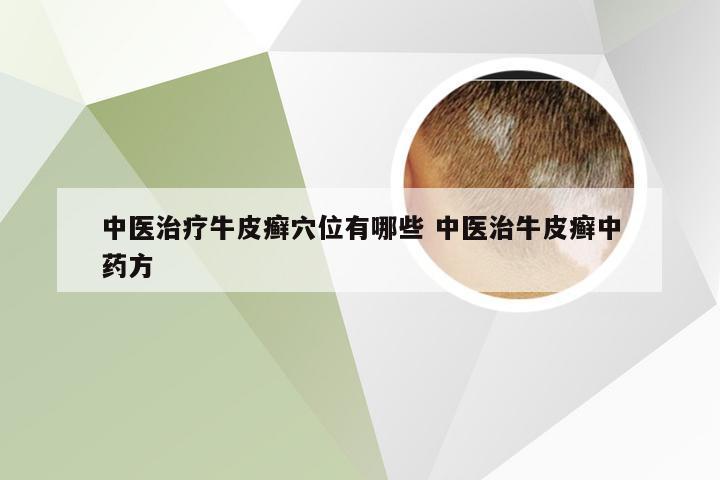 中医治疗牛皮癣穴位有哪些 中医治牛皮癣中药方