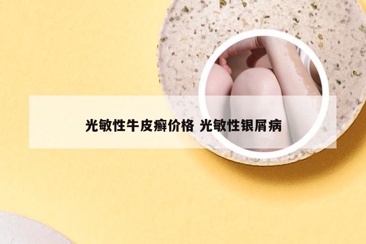 光敏性牛皮癣价格 光敏性银屑病