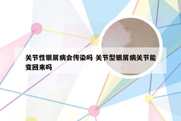 关节性银屑病会传染吗 关节型银屑病关节能变回来吗