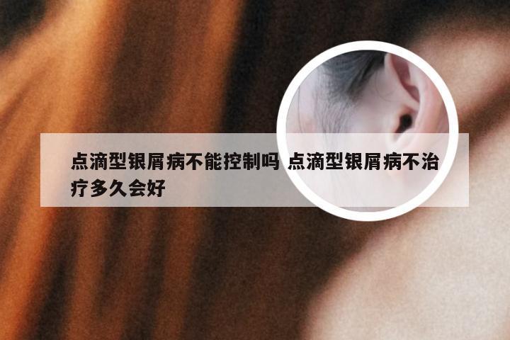 点滴型银屑病不能控制吗 点滴型银屑病不治疗多久会好