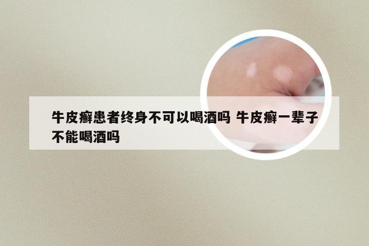 牛皮癣患者终身不可以喝酒吗 牛皮癣一辈子不能喝酒吗