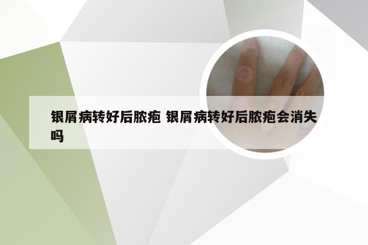 银屑病转好后脓疱 银屑病转好后脓疱会消失吗