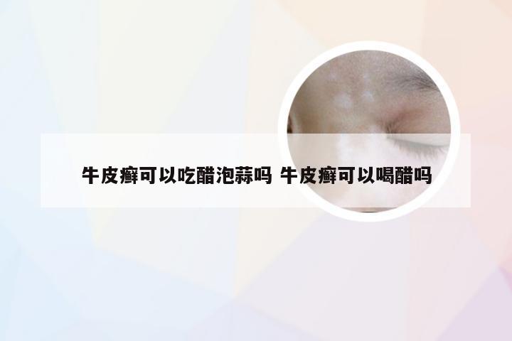 牛皮癣可以吃醋泡蒜吗 牛皮癣可以喝醋吗