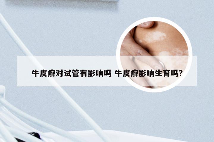 牛皮癣对试管有影响吗 牛皮癣影响生育吗?