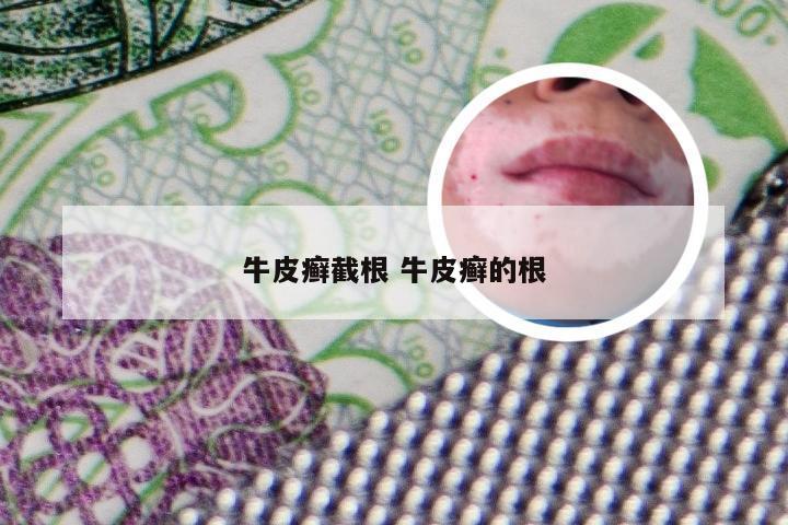 牛皮癣截根 牛皮癣的根