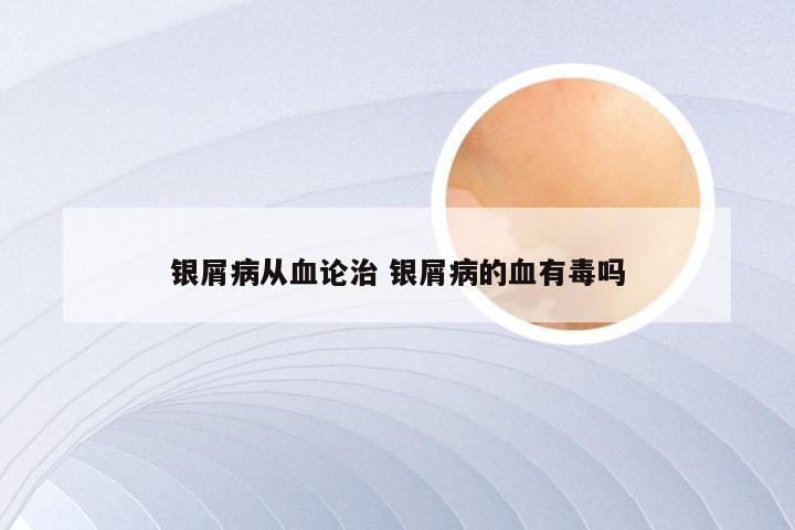 银屑病从血论治 银屑病的血有毒吗