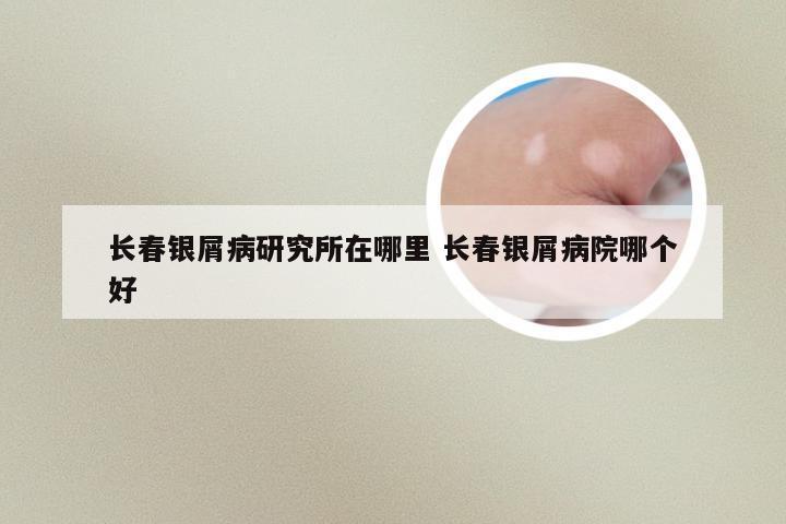 长春银屑病研究所在哪里 长春银屑病院哪个好