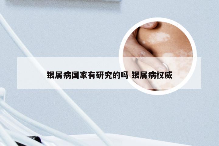 银屑病国家有研究的吗 银屑病权威