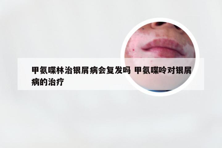 甲氨喋林治银屑病会复发吗 甲氨喋呤对银屑病的治疗