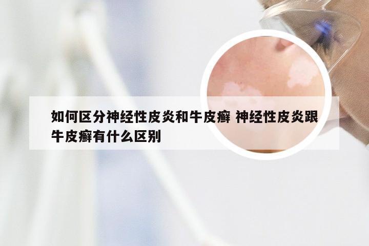 如何区分神经性皮炎和牛皮癣 神经性皮炎跟牛皮癣有什么区别