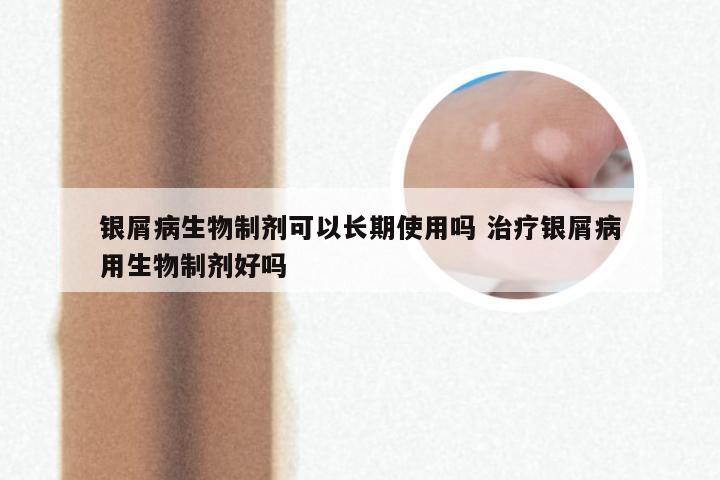 银屑病生物制剂可以长期使用吗 治疗银屑病用生物制剂好吗