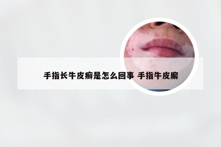 手指长牛皮癣是怎么回事 手指牛皮廨