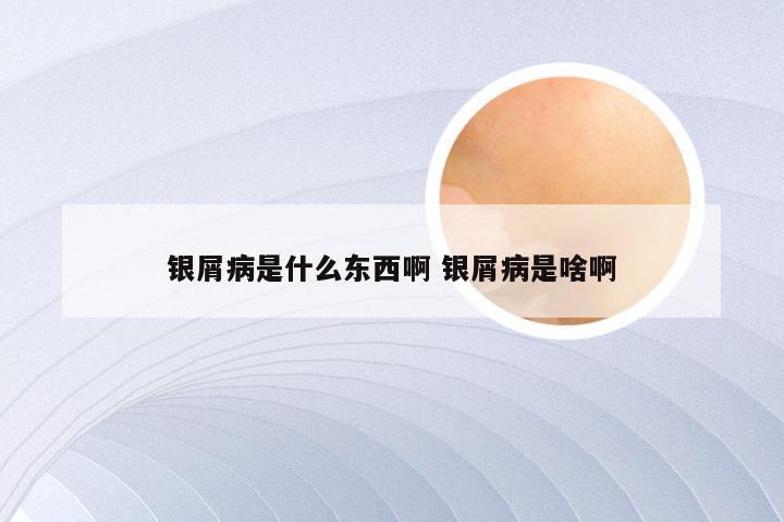 银屑病是什么东西啊 银屑病是啥啊