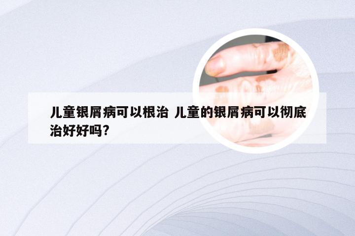 儿童银屑病可以根治 儿童的银屑病可以彻底治好好吗?