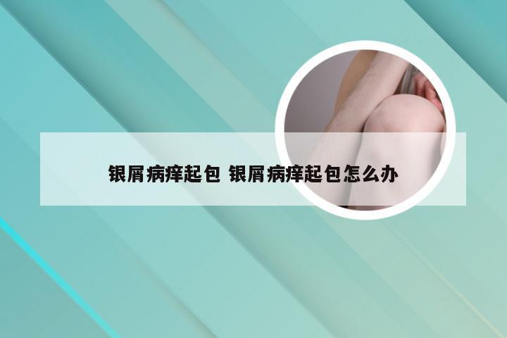 银屑病痒起包 银屑病痒起包怎么办