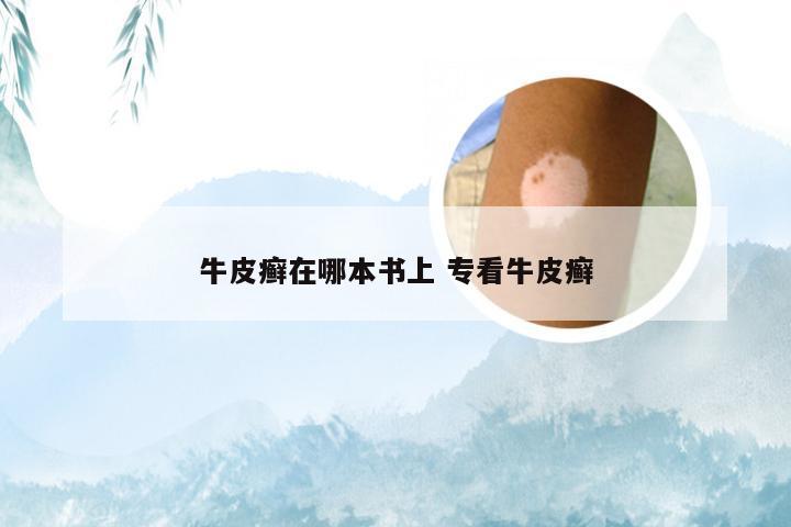 牛皮癣在哪本书上 专看牛皮癣