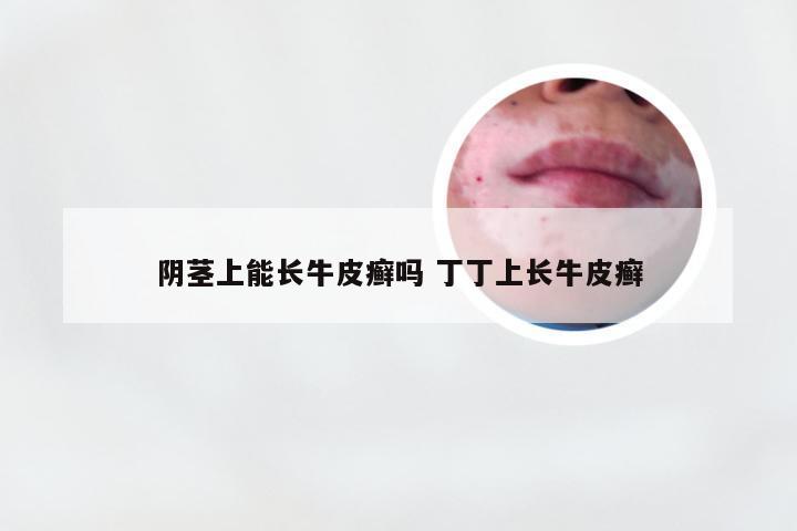 阴茎上能长牛皮癣吗 丁丁上长牛皮癣