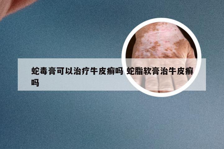 蛇毒膏可以治疗牛皮癣吗 蛇脂软膏治牛皮癣吗