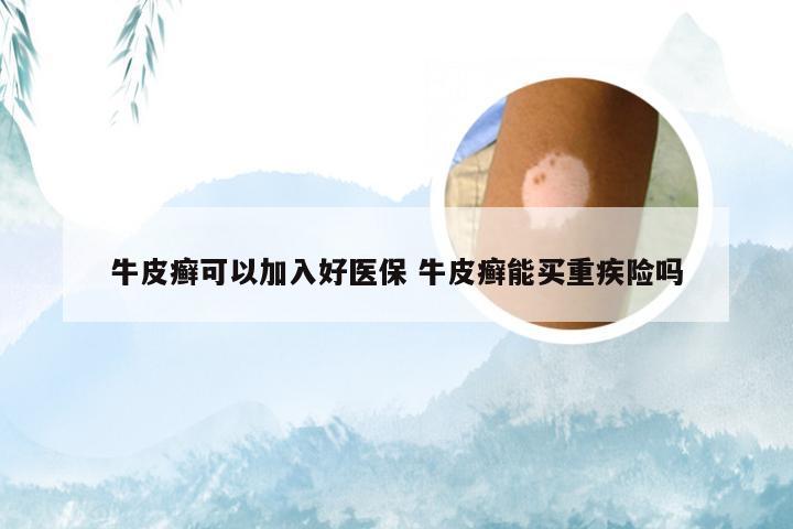 牛皮癣可以加入好医保 牛皮癣能买重疾险吗