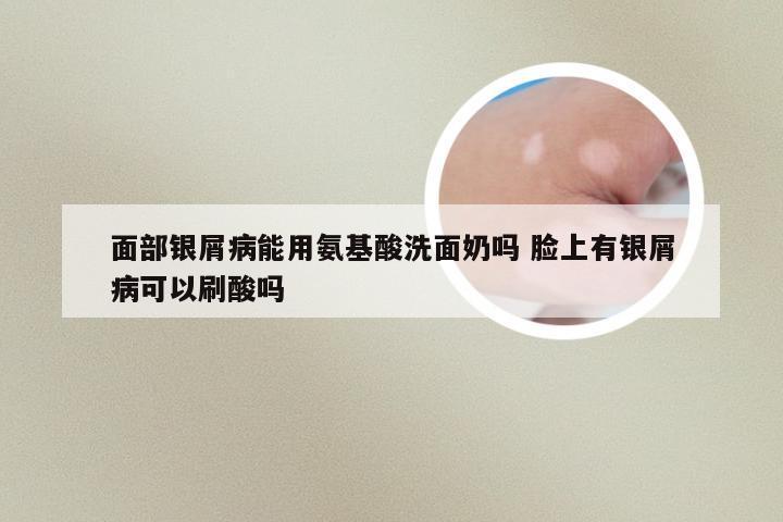 面部银屑病能用氨基酸洗面奶吗 脸上有银屑病可以刷酸吗