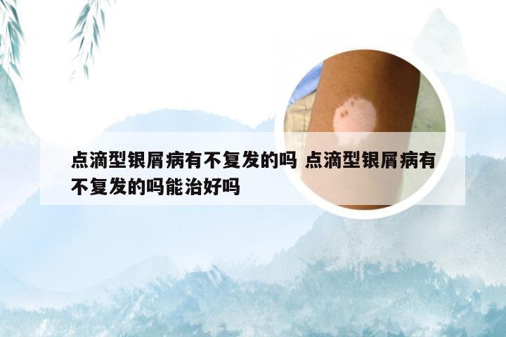 点滴型银屑病有不复发的吗 点滴型银屑病有不复发的吗能治好吗