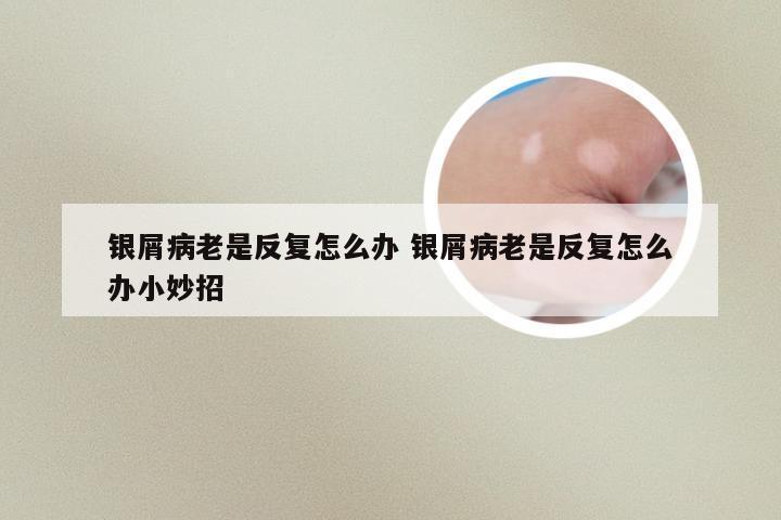 银屑病老是反复怎么办 银屑病老是反复怎么办小妙招