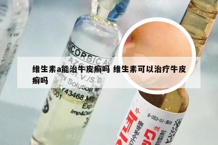 维生素a能治牛皮癣吗 维生素可以治疗牛皮癣吗