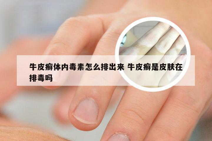 牛皮癣体内毒素怎么排出来 牛皮癣是皮肤在排毒吗