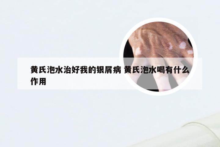 黄氏泡水治好我的银屑病 黄氏泡水喝有什么作用
