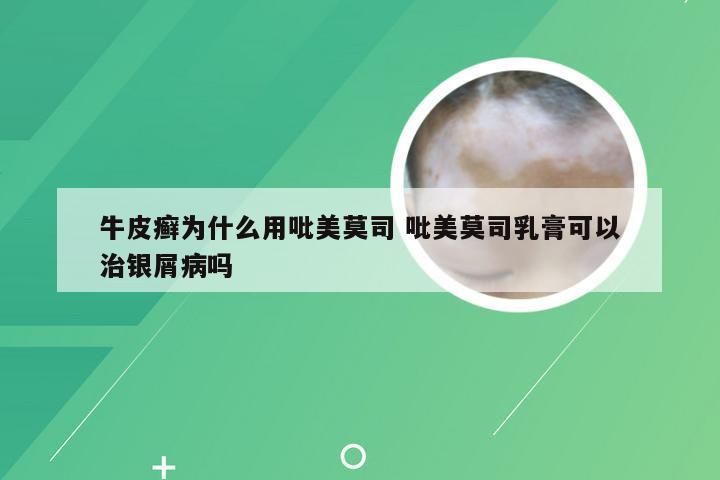 牛皮癣为什么用吡美莫司 吡美莫司乳膏可以治银屑病吗