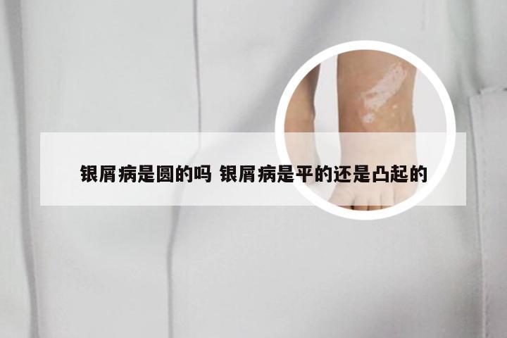 银屑病是圆的吗 银屑病是平的还是凸起的