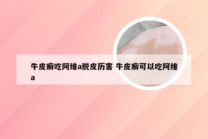 牛皮癣吃阿维a脱皮历害 牛皮癣可以吃阿维a