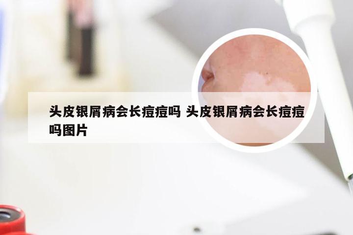 头皮银屑病会长痘痘吗 头皮银屑病会长痘痘吗图片