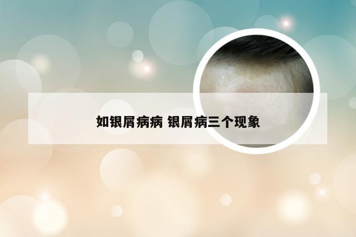 如银屑病病 银屑病三个现象