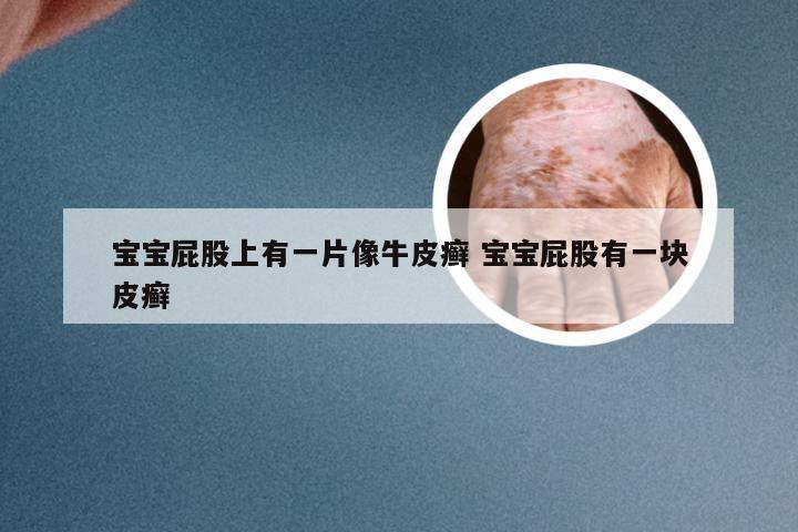 宝宝屁股上有一片像牛皮癣 宝宝屁股有一块皮癣