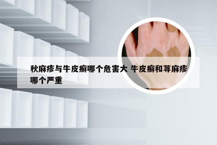 秋麻疹与牛皮癣哪个危害大 牛皮癣和荨麻疹哪个严重