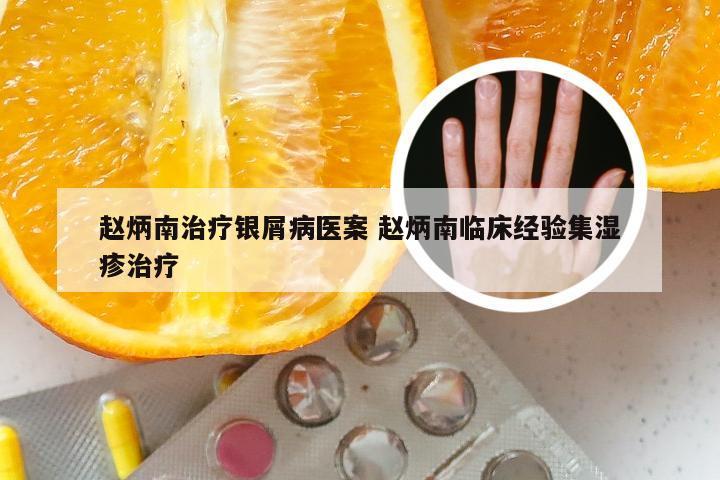 赵炳南治疗银屑病医案 赵炳南临床经验集湿疹治疗