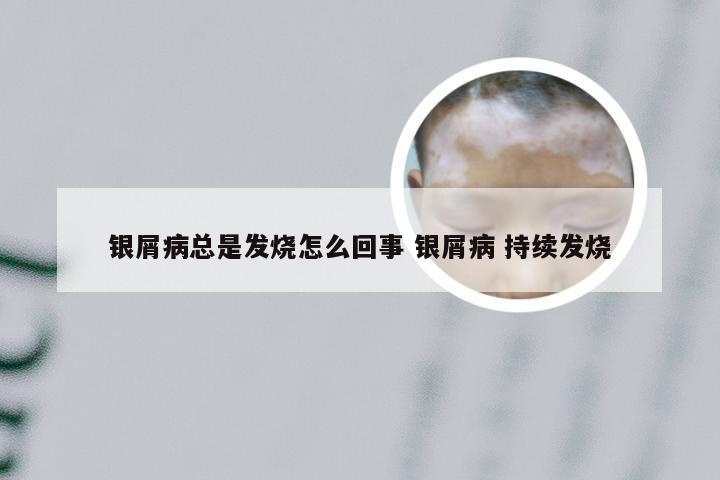 银屑病总是发烧怎么回事 银屑病 持续发烧