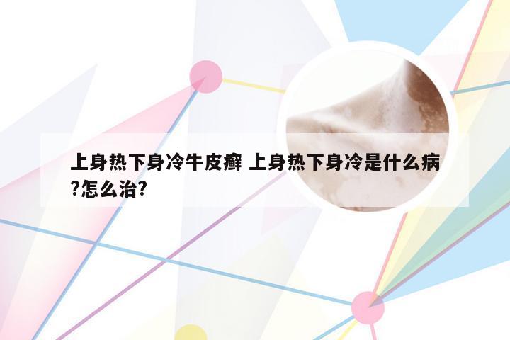 上身热下身冷牛皮癣 上身热下身冷是什么病?怎么治?