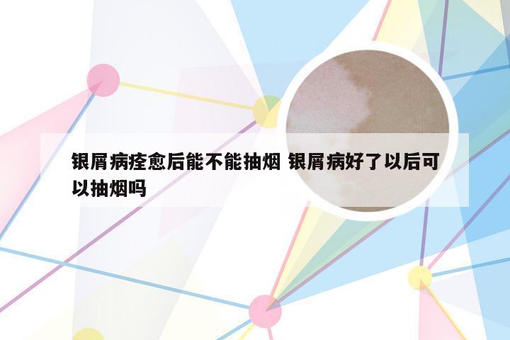 银屑病痊愈后能不能抽烟 银屑病好了以后可以抽烟吗