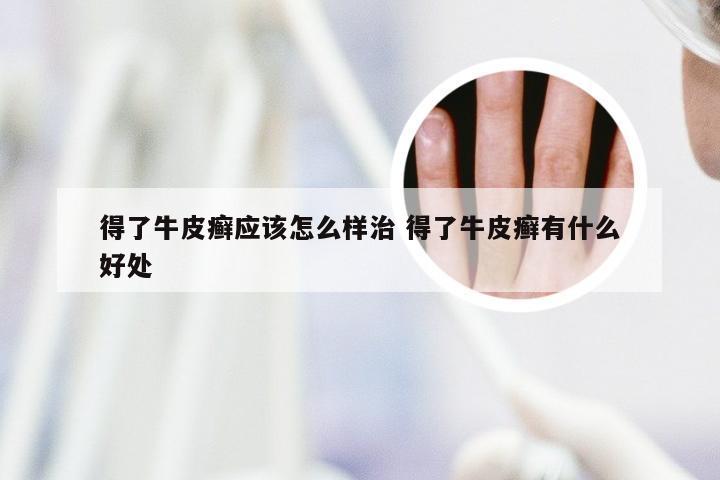 得了牛皮癣应该怎么样治 得了牛皮癣有什么好处